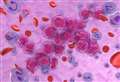 Drug combination could fight commonest childhood cancer, say Cambridge scientists